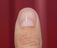 kluven nagel på de tumme. utvidgning av de nagel, traumatisk patologi. de nagel är dividerat i halv foto