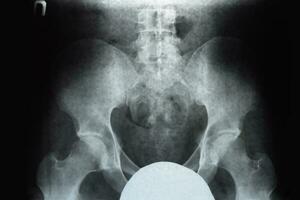 röntgen av de bäcken och korsben. röntgen foto