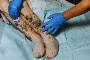 hud skador på de ben. symptom karakteristisk av de äldre Börja med en röd utslag i en små cirkel och spridning till en bredare område. stor skabb på de ben. äldre vård. konsekvenser av diabetes foto