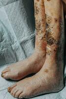 hud skador på de ben. symptom karakteristisk av de äldre Börja med en röd utslag i en små cirkel och spridning till en bredare område. stor skabb på de ben. äldre vård. konsekvenser av diabetes foto