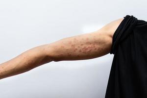 närbild dermatit på människans hand, allergisk utslag dermatit eksem hud av en patient. atopisk dermatit symptom hud detaljstruktur, hudsvamp. begreppet dermatologi.