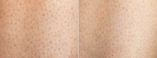 collage innan och efter hår avlägsnande. bild innan och efter ben hårstrån avlägsnande begrepp. stänga upp foto