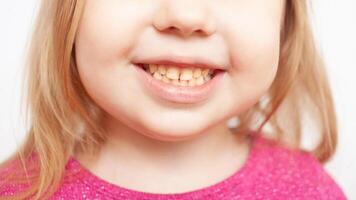 person ler, visar tänder, gul plack, krokig tänder, malocklusion. barndom foto