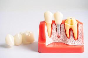 dental implantera, artificiell tand rötter in i käke, rot kanal av dental behandling, gummi sjukdom, tänder modell för tandläkare studerar handla om tandvård. foto