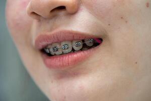 tandställning i Tonårs flicka mun till behandla och skönhet för öka förtroende och Bra personlighet. foto
