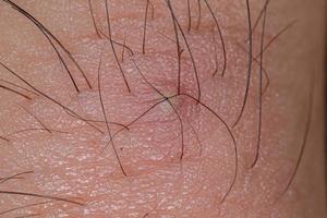 inflammation orsakad av inåtväxt hår foto