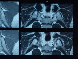 mri sacroiliac artikulation. studie av ankyloserande spondyloartrit patient. foto