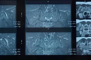 mri sacroiliac artikulation. studie av ankyloserande spondyloartrit patient. foto