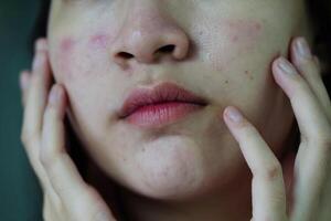 acne finne och ärr på huden ansikte, störningar av talgkörtlar, tonårsflicka hudvård skönhetsproblem. foto
