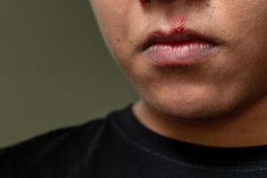 herpes virus och infektion behandling. män mun påverkade förbi herpes blåsor foto