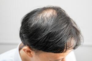 skallig i de mitten huvud och Börja Nej förlust hår glabrous av mogna asiatisk företag smart aktiva kontor man. foto