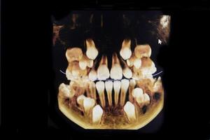 ct bild av de tänder av en 9-åring barn, med bebis tänder, i annorlunda projektioner. cbct av två käftar. foto