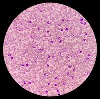grundläggande trombocytos blod smeta som visar onormal hög volym av trombocyt och vit blod celler. panmyelos. myeloprokiferativ oordning. foto