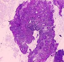 ileo-cecal ulcus. kronisk ospecifik ileit med ulcus. sektion visa ileal slemhinna, tät infiltration av lymfocyter, histiocyter, plasma cell i lamell propria. ibd. foto