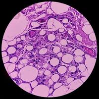 lipom på kubital fossa, godartad tillväxt av fet vävnad, godartad neoplasm, adipocyter, delvis kapslade tumör, 40x mikroskopisk se. foto
