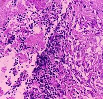 sköldkörtel cancer. mikroskopisk bild av follikulär neoplasm. malign neoplasma av atypiska sköldkörtel follikulär epitel celler. några av celler visa pleomorfism med kärn räfflor. nodulär struma. foto