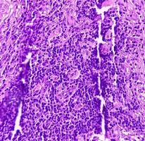 sköldkörtel cancer. mikroskopisk bild av follikulär neoplasm. malign neoplasma av atypiska sköldkörtel follikulär epitel celler. några av celler visa pleomorfism med kärn räfflor. nodulär struma. foto