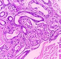 lipom på fransyska, godartad tillväxt av fet vävnad, godartad neoplasm, adipocyter, delvis kapslade tumör, 40x mikroskopisk se. foto