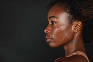 ai genererad profil av ung afrikansk amerikan kvinna med acne, hud problem foto