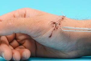 sår hand, suturering de sår. de typ av skära efter kirurgi. foto