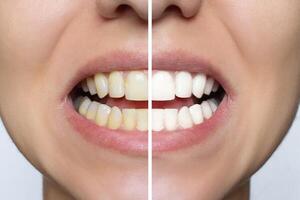 kvinnors tänder blekning närbild innan och efter de procedur. övre och lägre käke. dental klinik patient. isolerat på vit bakgrund. oral vård. dental behandling foto