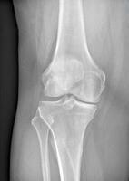röntgen av de ben av knä av en man. medicinsk begrepp. foto