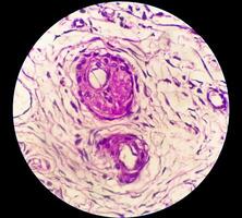 histologi, peritoneal inkludering cysta. paraovarian cystor, hydrosalpinx och låg grad cystisk mesoteliom är vanligtvis anses vara i de differentiell diagnos av bilder. foto