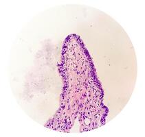 histopatologiska mikrofotografi av äggstockar cysta som visar metastatisk cystisk teratom. foto
