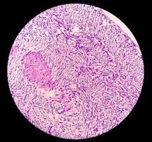 ben vävnad biopsi. fotomikrografisk bild som visar fibromyxom. ytlig acral fibromyxom, sällsynt långsam växande myxoid tumör. foto