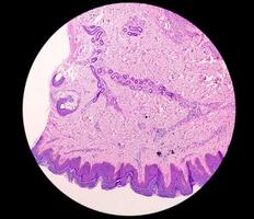 histologisk mikrofotografi. prurigo nodularis eller pn är en kronisk oordning av de hud. foto