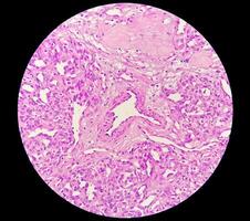 histologi, peritoneal inkludering cysta. paraovarian cystor, hydrosalpinx och låg grad cystisk mesoteliom är vanligtvis anses vara i de differentiell diagnos av bilder. foto