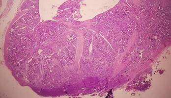 histologi, peritoneal inkludering cysta. paraovarian cystor, hydrosalpinx och låg grad cystisk mesoteliom är vanligtvis anses vara i de differentiell diagnos av bilder. foto