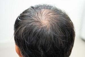 skallig i de mitten huvud och Börja Nej förlust hår glabrous av mogna asiatisk företag smart aktiva kontor man. foto