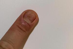 svamp nagel infektion onykomykos. torr grov hud av de ben foto