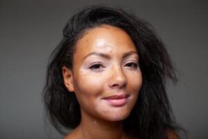 Lycklig svart kvinna med vitiligo pigmentering hud problem foto