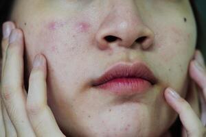 acne finne och ärr på huden ansikte, störningar av talgkörtlar, tonårsflicka hudvård skönhetsproblem. foto