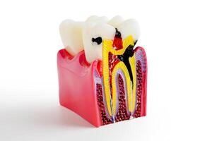 förfall tand byta ut med dental implantera rot kanal tänder modell för utbildning isolerat på vit bakgrund med klippning väg. foto