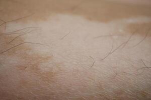 fötter med vitiligo hud skick. foto