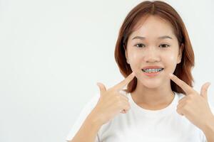 behandling. dental vård. skön asiatisk kvinna friska smile.metall konsoler på tänder. ung kvinna leende med tandställning och visa skön av tänder, vård efter tandställning, självsäker i ortodonti foto