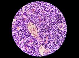 bröstcancermedvetenhet - mikroskopisk bild av kärnbiopsi för infiltrerande duktalt karcinom, upptäckt genom screening mammografi. invasivt duktalt karcinom, grad-ii foto