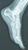kvinnliga fötter röntgenbild foto