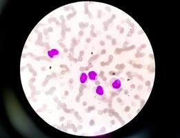 mikroskopisk bild av trombocytopeni-lågt antal blodplättar. hematologi, 100x foto