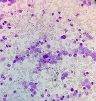 essentiell trombocytosblodprov som visar onormalt hög volym av blodplättar och vita blodkroppar analyseras med mikroskop. essentiell trombocytemi eller trombocytopeni. mikroskopisk bild av objektglaset. foto