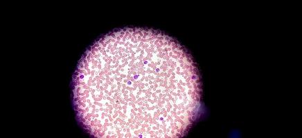 mikroskopisk vy av färgat objektglas av hematologi i laboratoriet. närbild. totalt blodvärde. foto