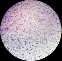 essentiell trombocytosblodprov som visar onormalt hög volym av blodplättar och vita blodkroppar analyseras med mikroskop. essentiell trombocytemi eller trombocytopeni. mikroskopisk bild av objektglaset. foto