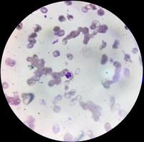 mikroskopisk bild av kall agglutininsjukdom. autoimmun hemolytisk anemi. cad foto