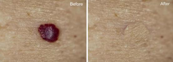 foto före och efter borttagning av mullvad på kvinnans hud. mullvad borttagning koncept