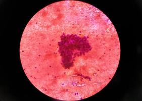 metastaserande adenokarcinom i lungan. pleuralvätskecytologi av lungpapillärt adenokarcinom, en typ av icke-småcelligt karcinom foto