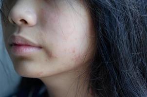 utslag ansikte kvinna allergisk mot kosmetika livsmedelsallergi eller luftallergi foto