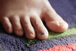 närbild av kvinnors infekterade fötter fingrar på sängen, foto